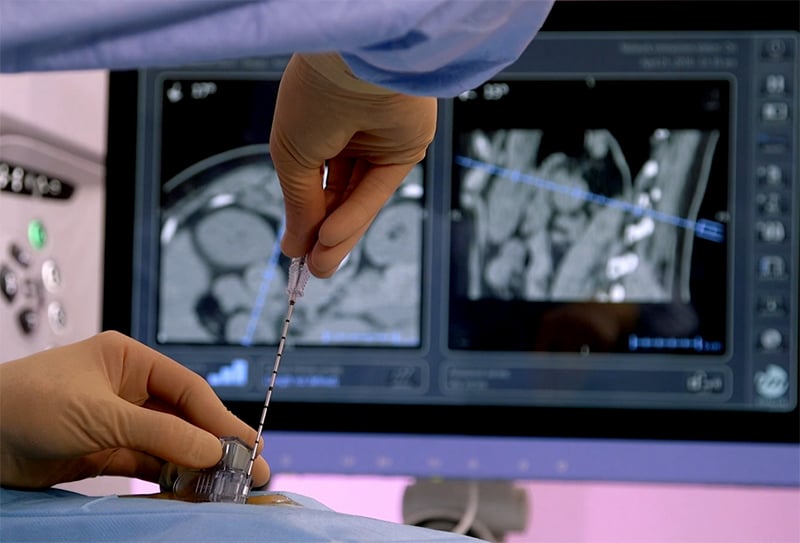 Radiologie interventionnelle : une solution innovante est licenciée par la SATT Aquitaine à la société IMACTIS.